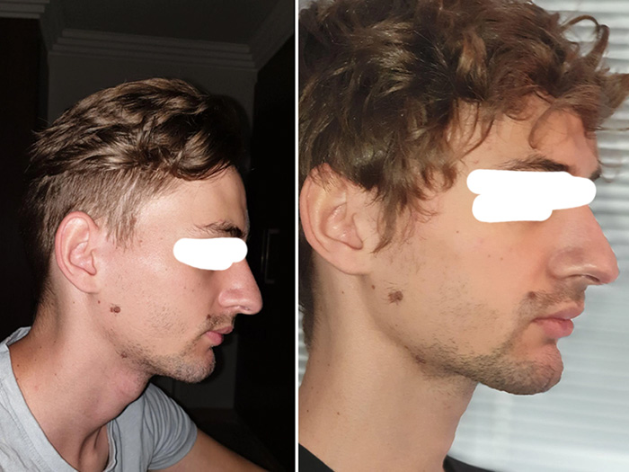 4 months mewing before and after results